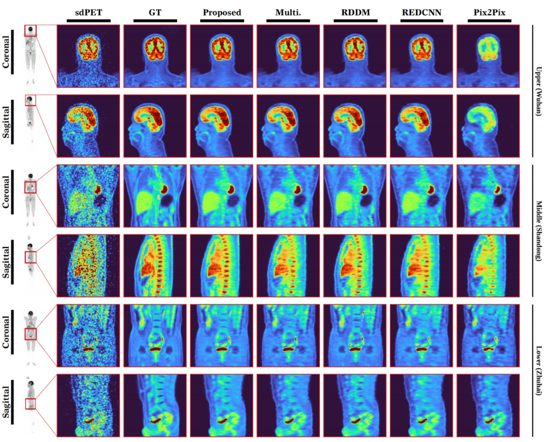Medical Image Analysis | 破解低计数PET成像难题：新型AI框架实现快速精准成像